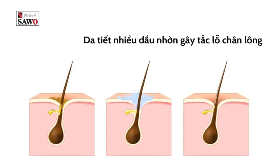 Nguyên nhân gây mụn